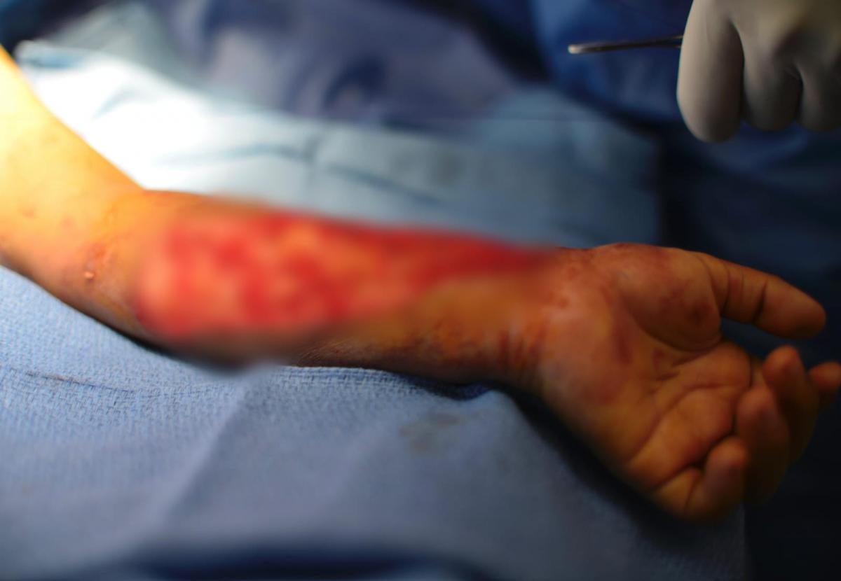 Shriners-Children, hospital de Texas que cura niños quemados de Veracruz